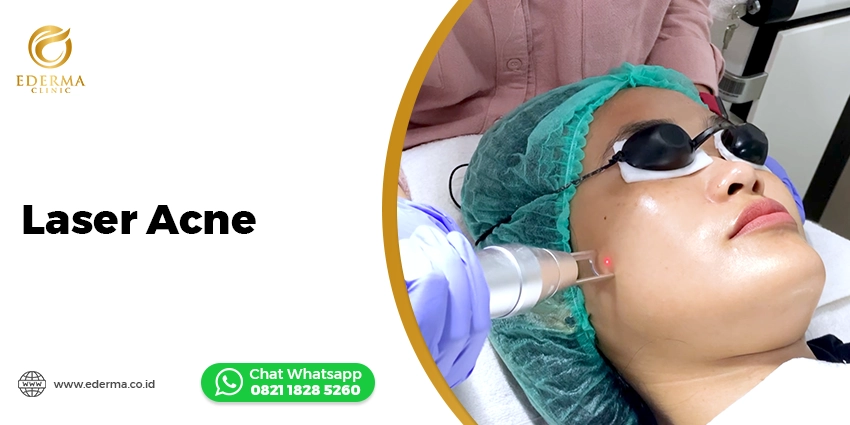 Laser Acne