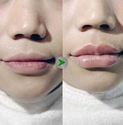 Before After - Filler