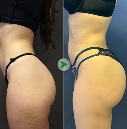 Before After - Buttock Augmentation 001