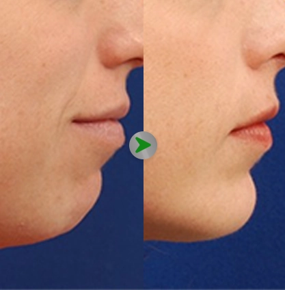 Ilustrasi - Chin Augmentation