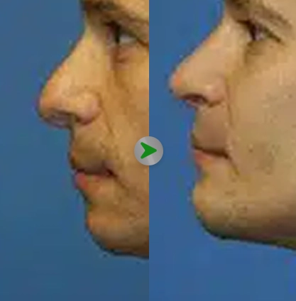 Before After - Jaw Contouring 001