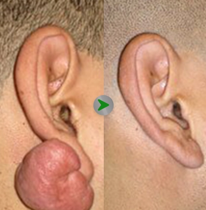 Before After - Keloid Surgery 001