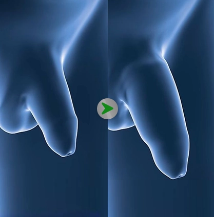 Ilustrasi Operasi Memperbesar Penis