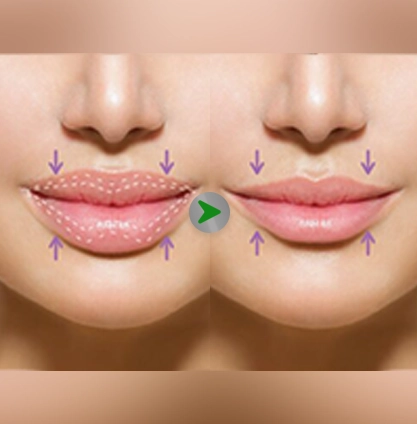 Before After - Lip Reduction 001