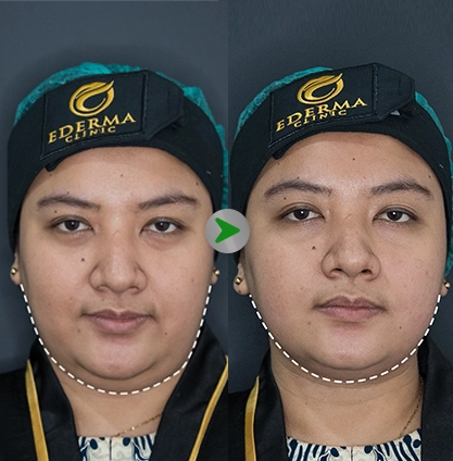 Before After - Mesolipo Face 001