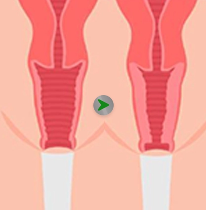 Before After - Operasi Merapatkan Miss V 001