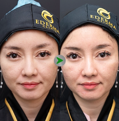 Before After - Peeling Acne 001