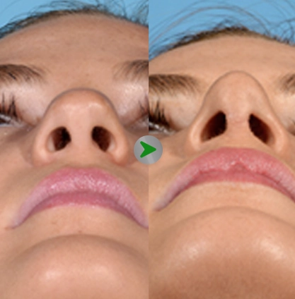 Before After - Tip Rhinoplasty 001