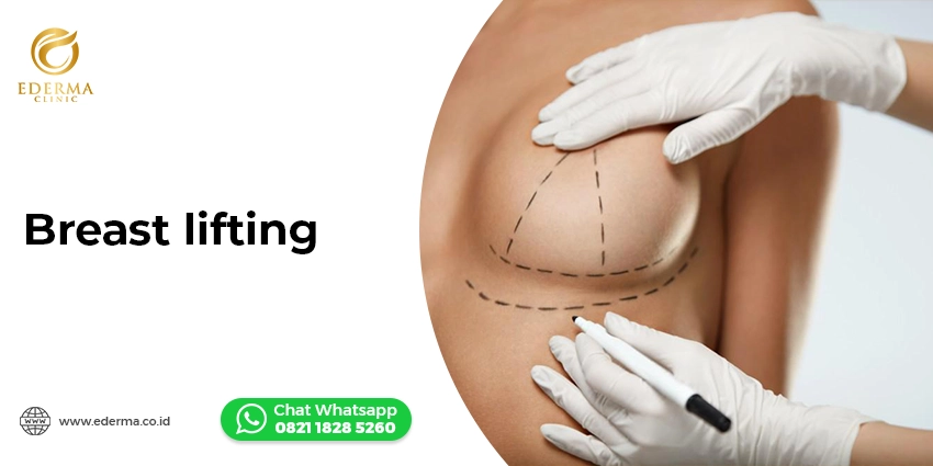 Breast lifting