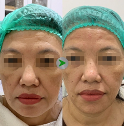 Before After - Botox Rahang