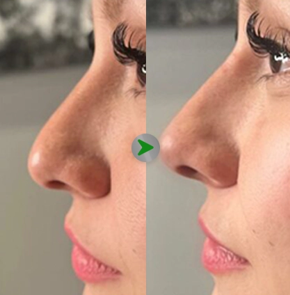 Before After - Filler Hidung