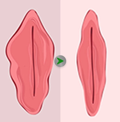 Before After - Labiaplasty 001