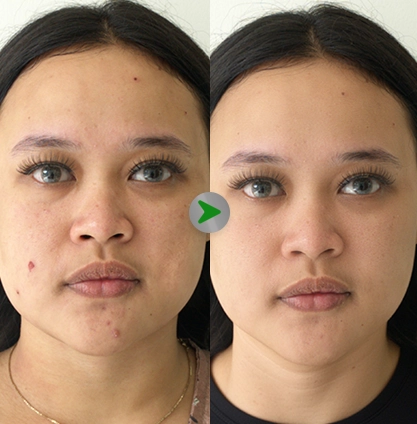Before After - RF Fractional 001