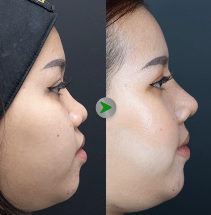 Before After - Rhinoplasty 001