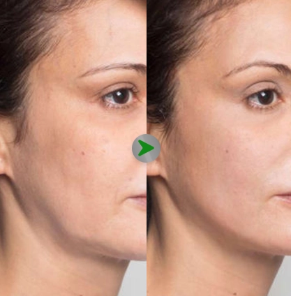 Before After - Tarik Benang Wajah Murah di Jakarta