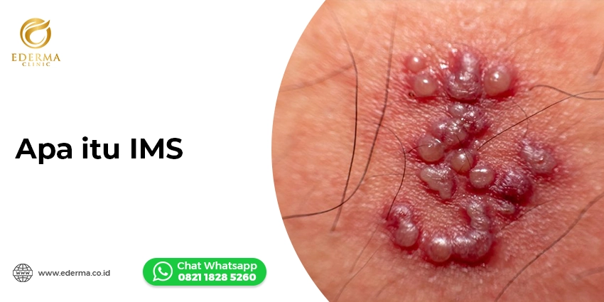 Cover - Infeksi Menular Seksual