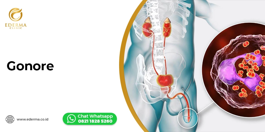 Tindakan - Biaya Suntik Gonore di Jakarta