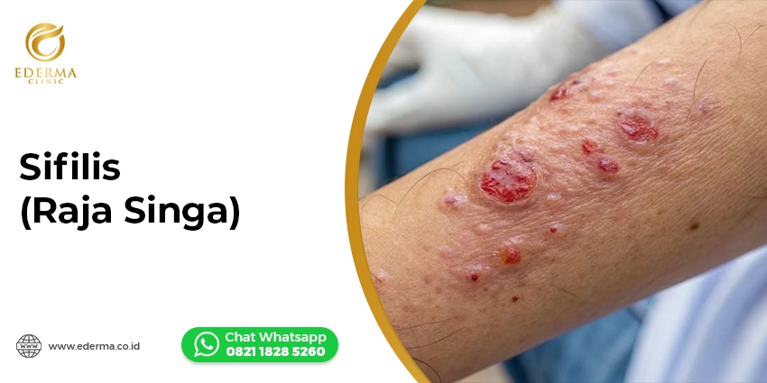 Tindakan - Biaya Tes Penyakit Menular Seksual