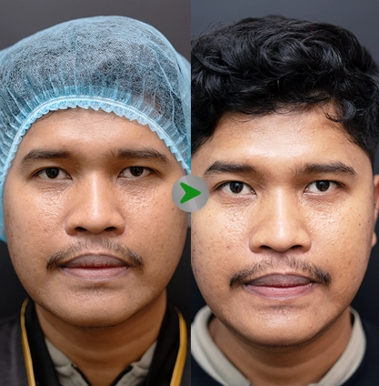 Before After - Harga Pico Laser 001