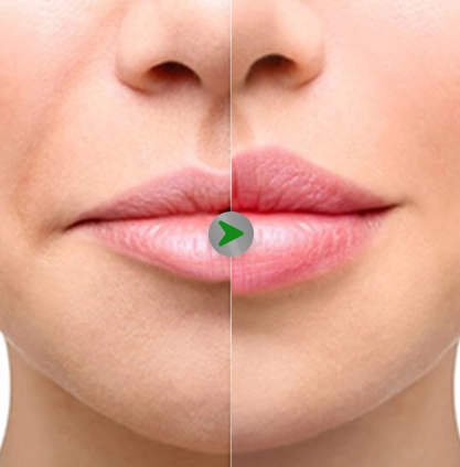 Before After - Operasi Bibir Tebal