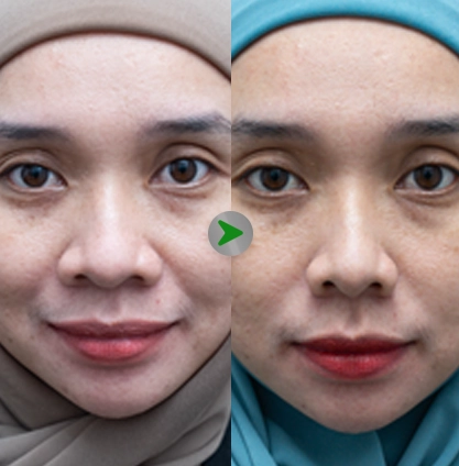 Before After - Operasi Cuping Hidung