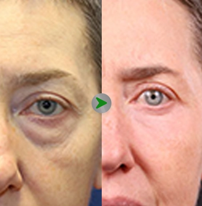 Before After - Operasi Kantung Mata