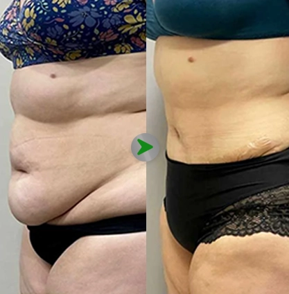 Before After - Operasi Sedot Lemak