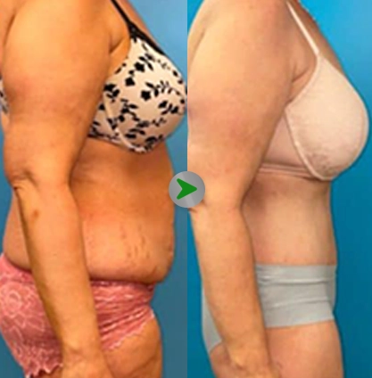 Before After - Operasi Tummy Tuck