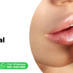 Cover - Operasi Bibir Tebal