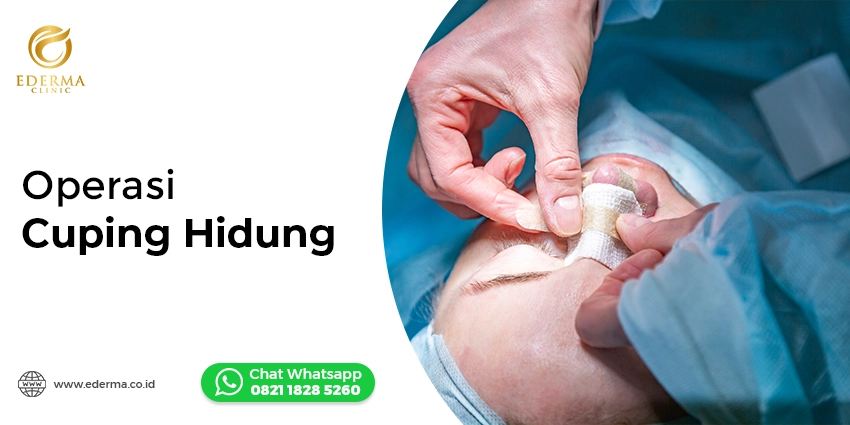 Operasi Cuping Hidung | Solusi Aman & Natural di Ederma Clinic