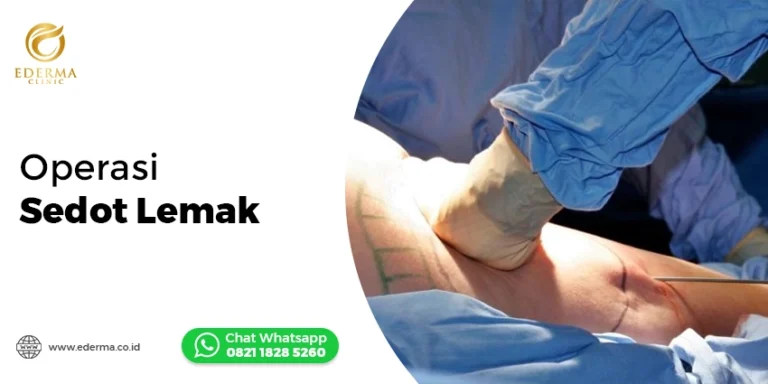 Operasi Sedot Lemak: Solusi Tubuh Ideal di Ederma Clinic Indonesia
