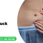 Cover - Operasi Tummy Tuck
