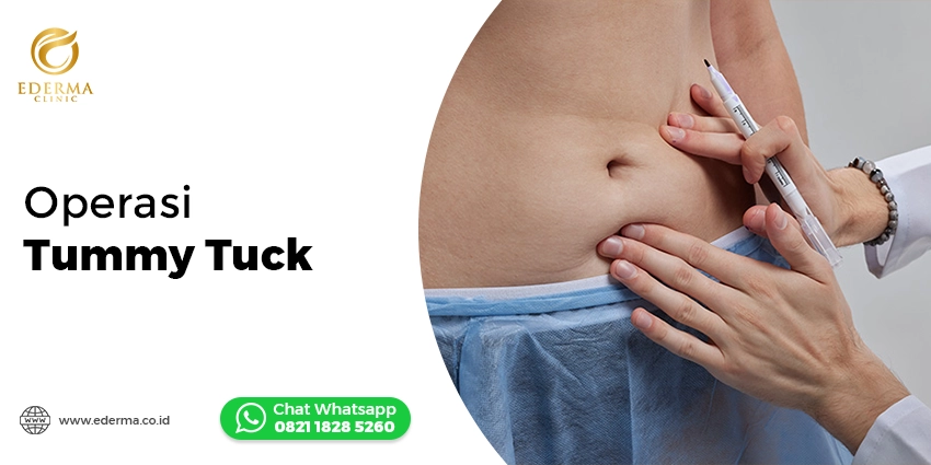 Cover - Operasi Tummy Tuck