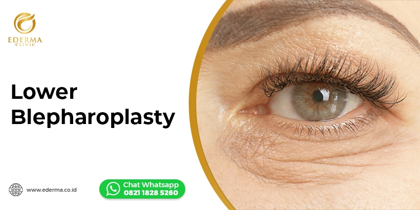 Tindakan - Operasi Kantung Mata