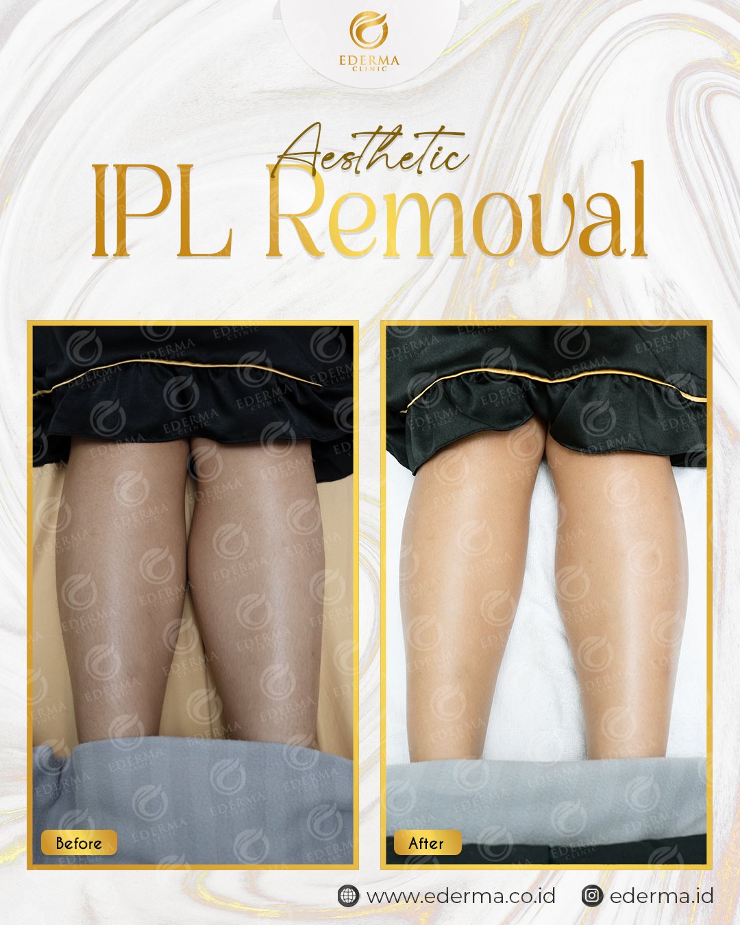 LEG IPL REMOVAL