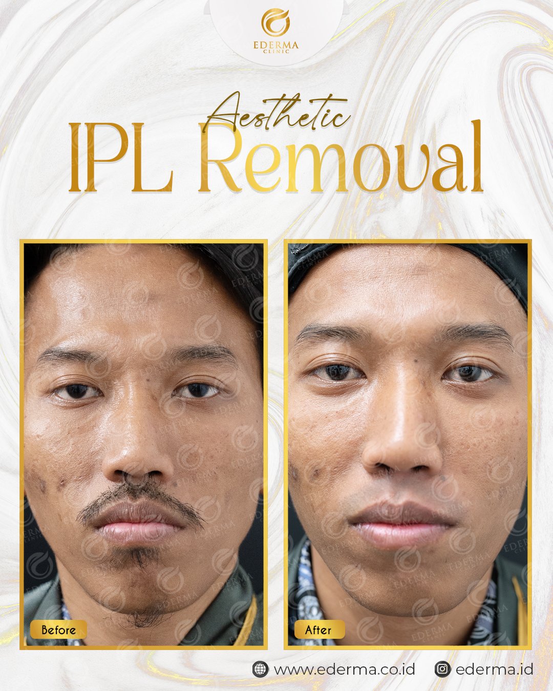 MUSTACHE IPL REMOVAL
