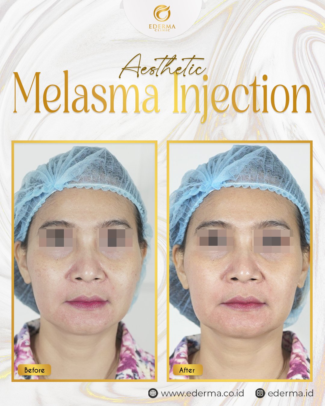 MELASMA INJECTION