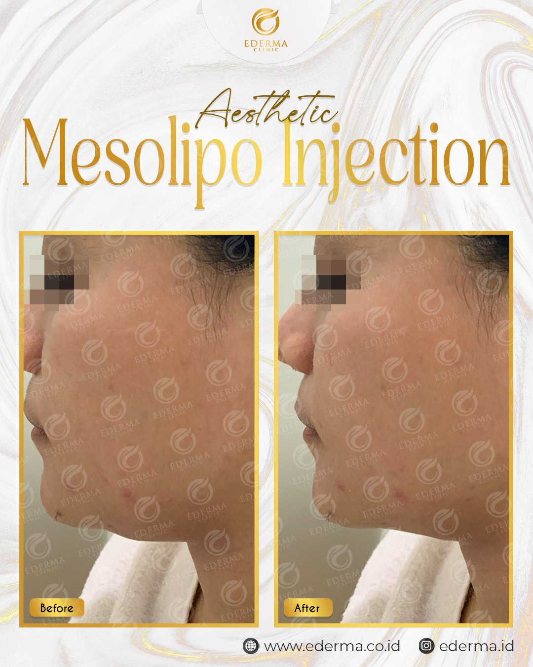 MESOLIPO INJECTION