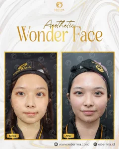 Before-After-Aesthetic-Wonder-Face