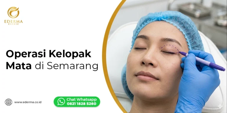 Operasi Kelopak Mata (Blepharoplasty) di Semarang
