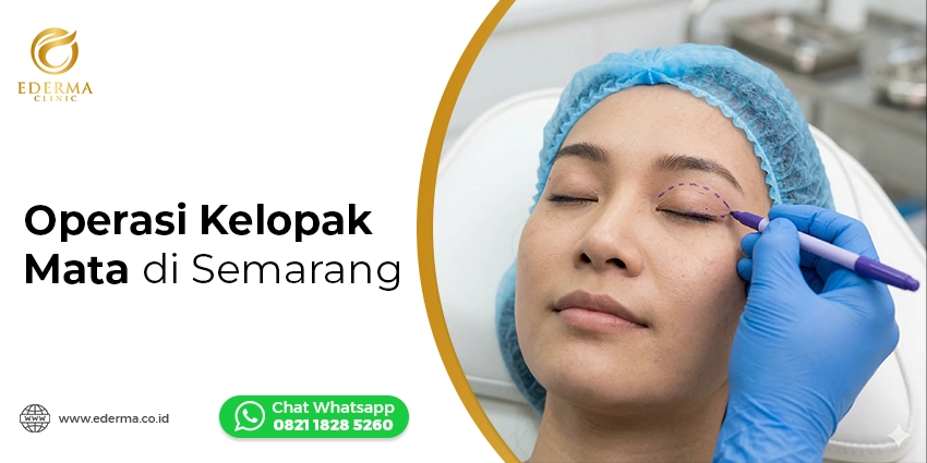 operasi-blepharoplasty-semarang