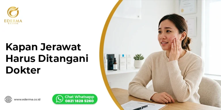 Kapan Jerawat Harus Ditangani Dokter?
