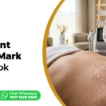 treatment stretch mark Lombok Ederma Clinic