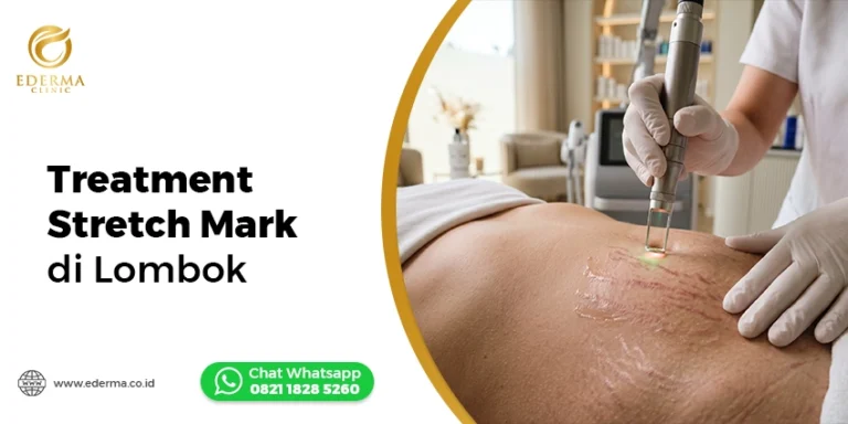 Treatment Stretch Mark Lombok