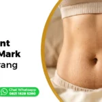 treatment stretch mark di Semarang Ederma Clinic