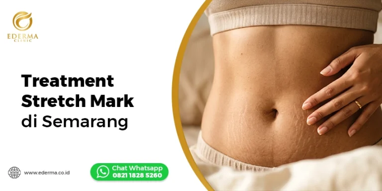 Rekomendasi Treatment Stretch Mark di Semarang yang Banyak Dicari