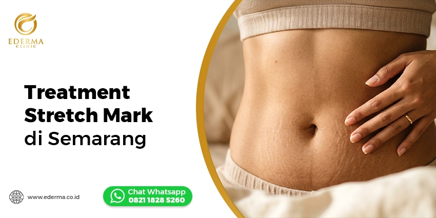 treatment stretch mark di Semarang Ederma Clinic