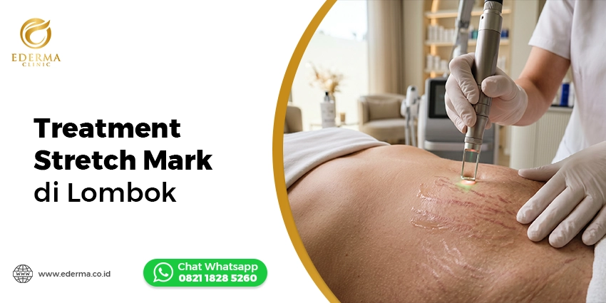 treatment stretch mark Lombok Ederma Clinic