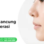 nose threadlift hidung mancung tanpa operasi Ederma Clinic