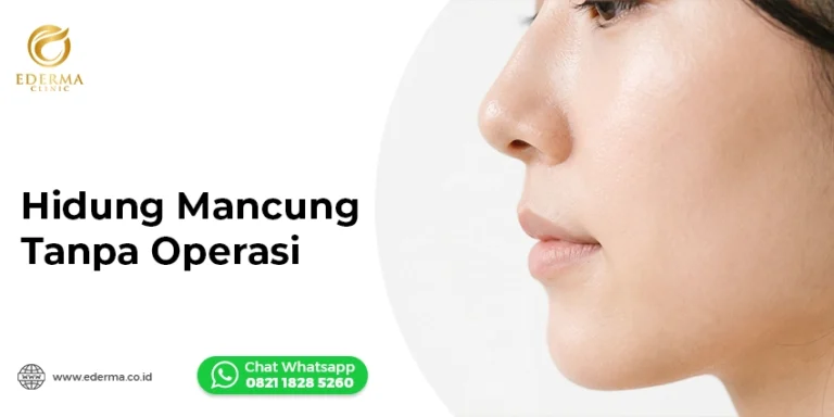 Nose Threadlift: Hidung Mancung Tanpa Operasi — Ederma Clinic